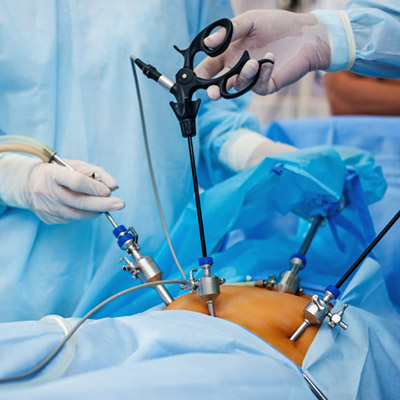  Laparoscopic surgery